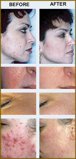 cold laser therapy before and after examples