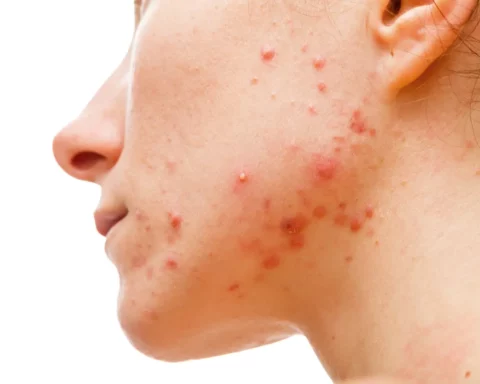 Acne on the Jawline