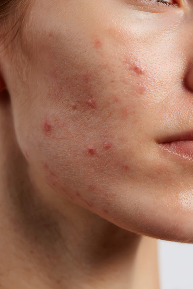 Acne Pimples on Young Womans Face