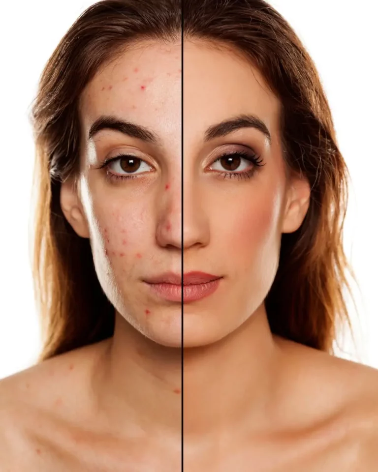 Acne Problem Skin Before After