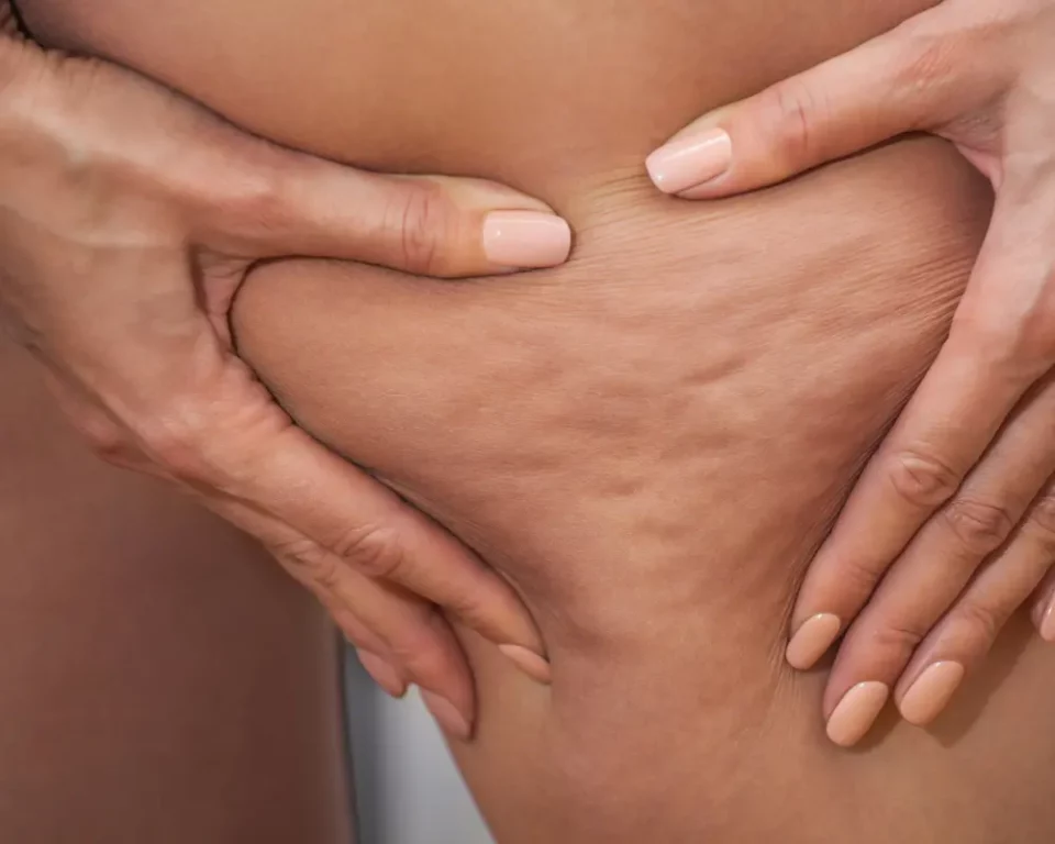 Cellulite on Leg