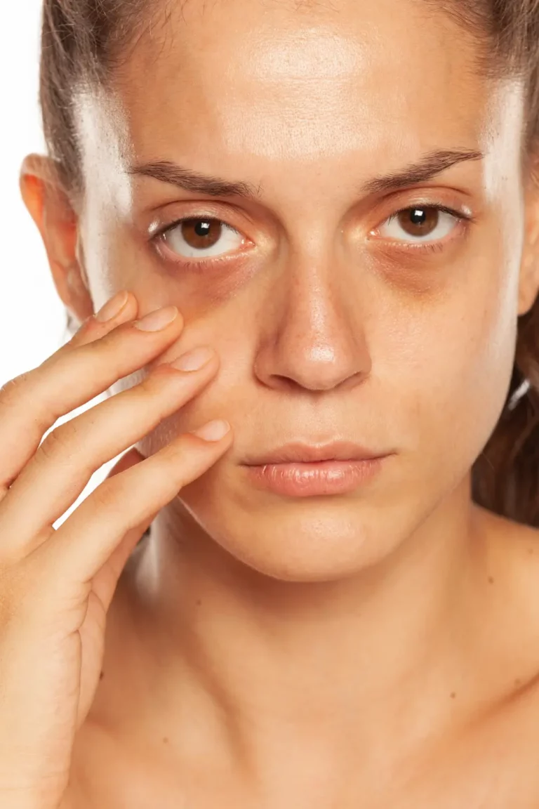 Dark Circles Under Eyes of a Young Woman