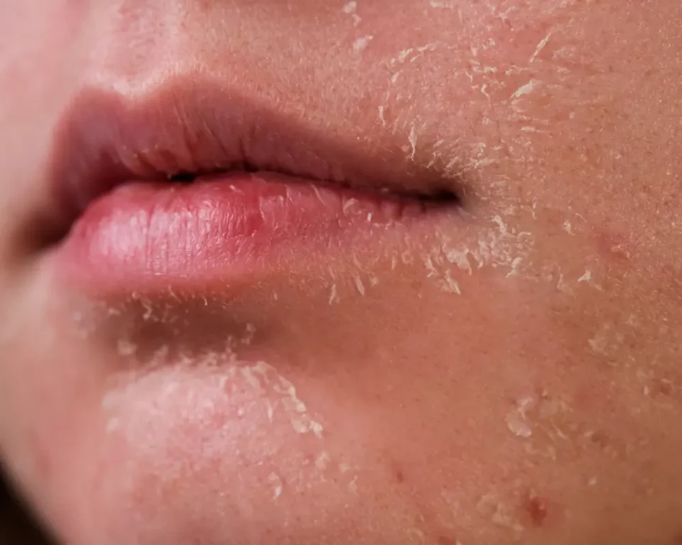 Dry Skin on Face and Lips