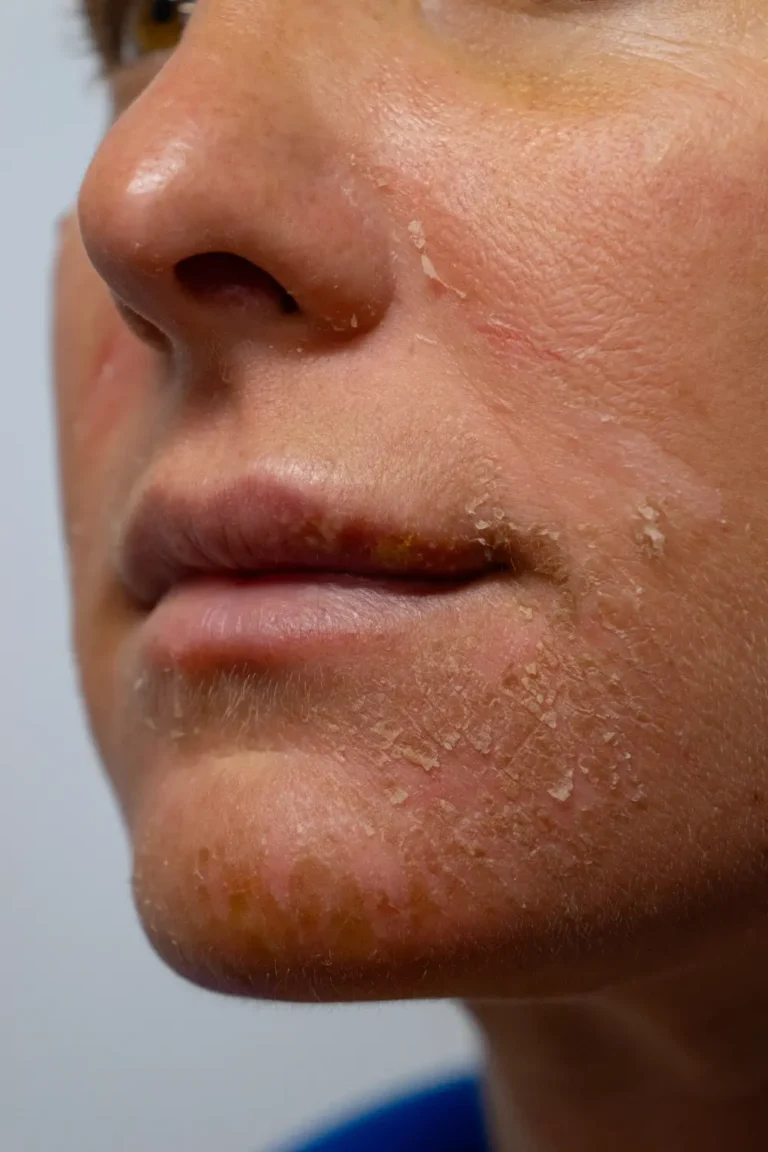 flaky facial skin on a young woman