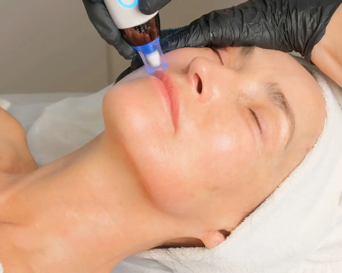 Microneedling Facial Being Performed on Womans Face_upscale