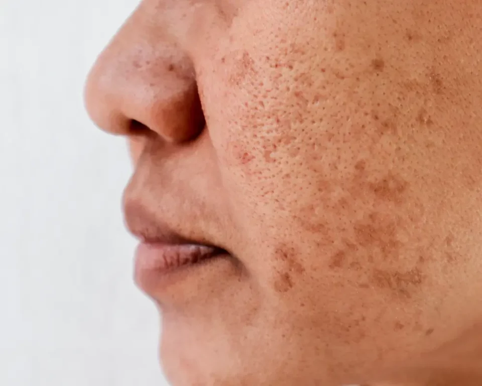Pigmentation issue