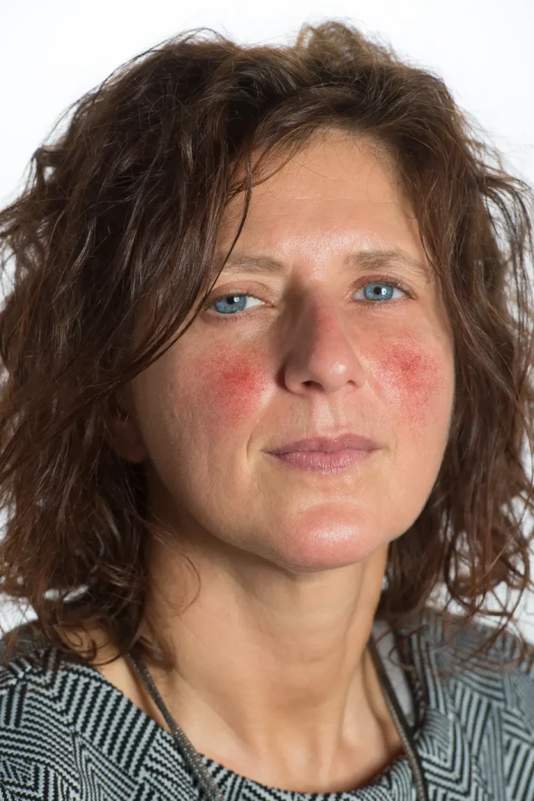 Red Cheeks from Rosacea