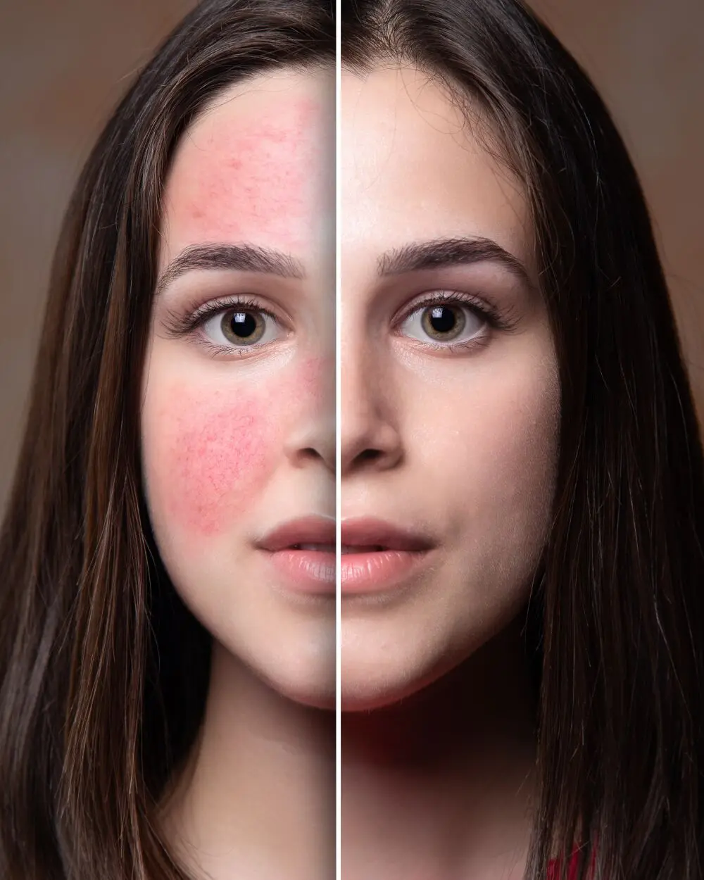 Rosacea Problem Skin Before After