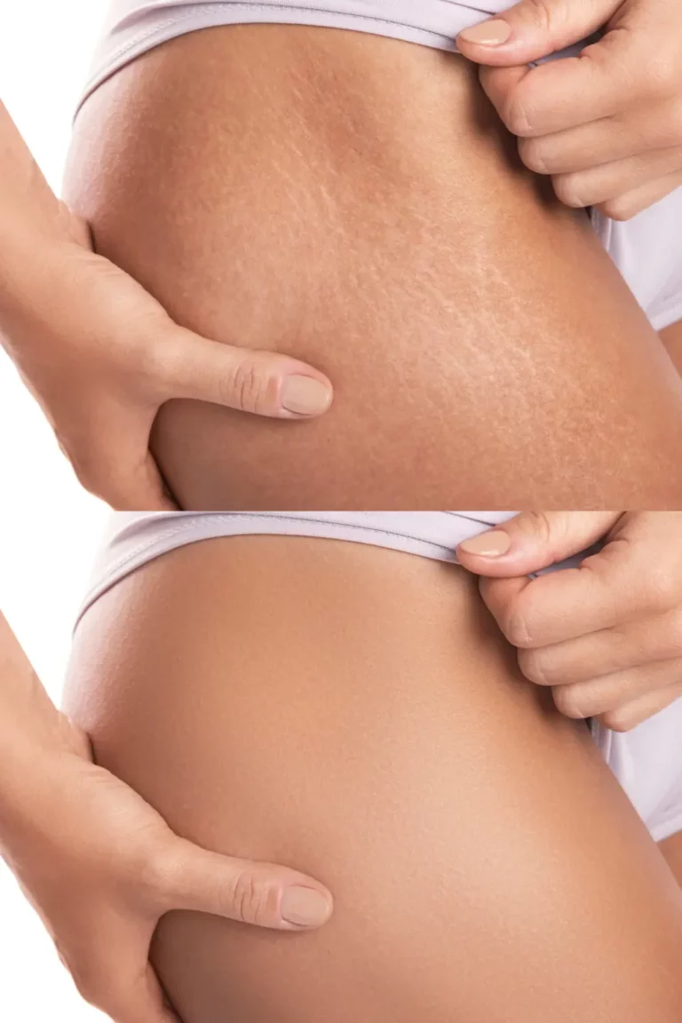 Stretch Marks Scars on a Womans Leg