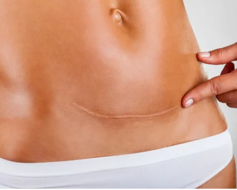 Surgical Scar from Caesarean Section